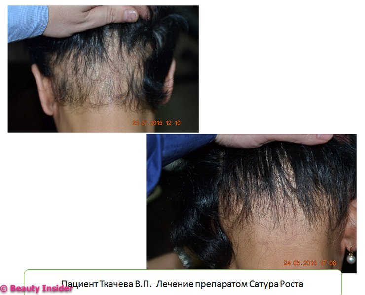 Інтенсифікації обмінних процесів в шкірі   Поліпшенню загоєння ран   Стимуляції росту волосся   Можливе відновлення пігментації волосся